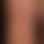 Purpura eczematide-like purpura: non-symptomatic (no itching) eczema-like disease that has been r...