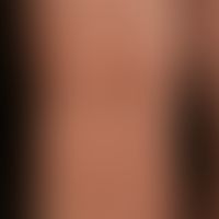Purpura eczematide-like purpura: non-symptomatic (no itching) eczema-like disease that has been r...