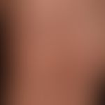 Purpura eczematid-like Purpura: explanatory detail.
