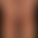 Purpura eczematide-like purpura: non-symptomatic (no itching) eczema-like disease that has been r...