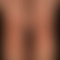 Purpura ekzematid-like Purpura: seit Monaten rezidivierend verlaufende, nicht-symptomatische (kei...