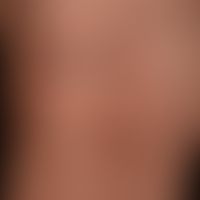 Purpura ekzematid-like Purpura: erklärende Detailaufnahme.
