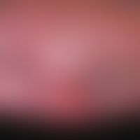Sézary syndrome: severe final febrile developmental stage. universal redness of the skin with ext...