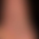 Syphilis Frühsyphilis:&nbsp; psoriasiformes papulöses Plantarsyphilid als Teilmanifestation eines...