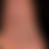 Syphilis Early syphilis: psoriasiform papular plantar syphilis as a partial manifestation of a ge...