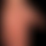 Syphilis Frühsyphilis:&nbsp; psoriasiformes papulöses Palmarsyphilid als Teilmanifestation eines ...