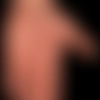 Syphilis Early syphilis: psoriasiformes papular palmarsyphilid as partial manifestation of a gene...