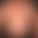 Exogenous Cushing's syndrome with pronounced trunk obesity and broad red stria cutis distensae.
