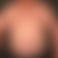 Exogenous Cushing's syndrome with pronounced trunk obesity and broad red stria cutis distensae.

