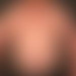 Stria cutis distensae bei exogenem Cushing-Syndrom.
