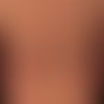 Skleromyxoedem: Multiple, symmetrisch verteilte, 0,1-0,2 cm große, rundliche, nicht follikuläre&n...
