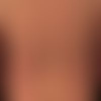 Scleromyxoedema: Multiple, symmetrically distributed, 0.1-0.2 cm large, roundish, non follicular ...