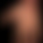 Skleromyxoedem: wachsartig flächenhaft&nbsp;verhärtete Handflächen. Veränderungen v.a. an den Fin...