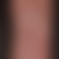 Verrucae vulgares. up to 0.6 cm in size, skin-coloured to yellowish, chronic, rough papules and n...