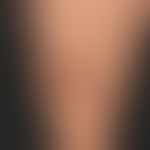 Erythema induratum (Noduläre Vaskulitis):&nbsp; Die 48 Jahre alte Patientein leidet seit&nbsp;2 J...