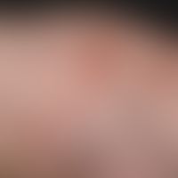 Mastocytomas cutaneous: reddish-brown plaques that appear in the first months of life and cause s...