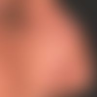 Nodular basal cell carcinoma in Xeroderma pigmentosum: solitary, broadly based, firm, painless, c...