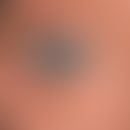 Xeroderma pigmentosum: 43-Jahre alter irakisch geborener Patient&nbsp;&nbsp;mit poikilodermatisch...