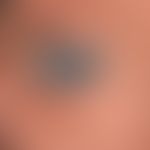 Xeroderma pigmentosum: 43-Jahre alter irakisch geborener Patient&nbsp;&nbsp;mit poikilodermatisch...