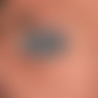 Xeroderma pigmentosum: 43-Jahre alter irakisch geborener Patient&nbsp;&nbsp;mit poikilodermatisch...