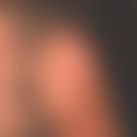 Xeroderma pigmentosum: 43-Jahre alter irakisch geborener Patient&nbsp;&nbsp;mit poikilodermatisch...