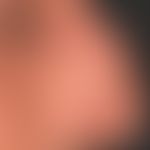 Xeroderma pigmentosum: 43-Jahre alter irakisch geborener Patient&nbsp;&nbsp;mit poikilodermatisch...