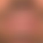 Schwere aktinische Cheilitis bei Xeroderma pigmentosum: 43-Jahre alter irakisch geborener Patient...
