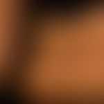 Erythema dyschromicum perstans. 43 Jahre alte Frau. Seit mehreren&nbsp; Monaten ursächlich völig ...