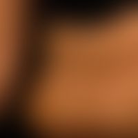 Erythema dyschromicum perstans. 43 Jahre alte Frau. Seit mehreren&nbsp; Monaten ursächlich völig ...