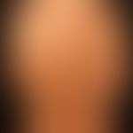 Atrophodermia idiopathica et progressiva: slowly progressive, large, brown, non-symptomatic patches
