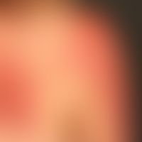 Pronounced. large-area allergic contact eczema: large, blurred (scattered edges), itchy, red, rou...