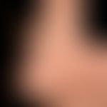 Malformation, venöse : nur kosmetisch störende venöse Malformation; unterschiedliche Füllungszust...