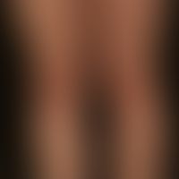 Scleroderma circumscripts (type band-shaped circumscripts scleroderma). 32-year-old woman, for ye...