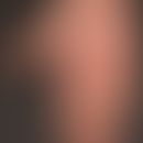 Tinea manuum:&nbsp;seit längerem besteht bei dem 42-jährigen Patienten diese großflächige, "gut g...