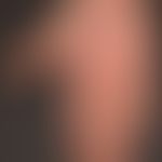 Tinea manuum:&nbsp;seit längerem besteht bei dem 42-jährigen Patienten diese großflächige, "gut g...