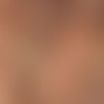 Pityriasis amiantacea: massive fatty scaling; the hair shafts are matted to yellowish strands; ha...
