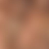 Pityriasis amiantacea: massive fatty scaling; the hair shafts are matted to yellowish strands; ha...