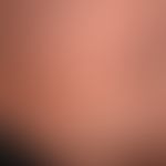 Acute urticaria, acute exanthema with multiple, disseminated, flat-elevated, intensely itching re...