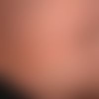 Acute urticaria, acute exanthema with multiple, disseminated, flat-elevated, intensely itching re...