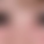 Angioedema: idiopathic, acute and for the first time opened angioedema with massive swelling of t...