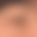 Angioedema: acutely occurring, non-itching swelling of the upper and lower eyelids bds. cause unk...