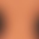 Pityriasis versicolor alba: regellos verteilte, symptomlose,&nbsp;helle Flecken, die nach mehrfac...