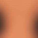 Pityriasis versicolor alba: regellos verteilte, symptomlose,&nbsp;helle Flecken, die nach mehrfac...