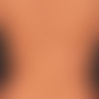 Pityriasis versicolor alba: irregularly distributed, symptomless, bright spots that appeared afte...