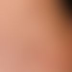Lichen aureus: therapy-refractory variant of Purpura pigmentosa progressiva. lichenoid papules an...