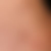Lichen aureus: therapy-refractory variant of Purpura pigmentosa progressiva. lichenoid papules an...
