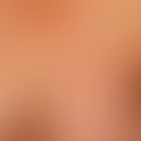 Lymphom kutanes blastisches NK-Zell-Lymphom: generalisiertes Krankheitsbild mit multiplen,&nbsp;r...