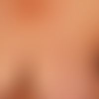 Lymphom kutanes blastisches NK-Zell-Lymphom: generalisiertes Krankheitsbild mit multiplen,&nbsp;r...