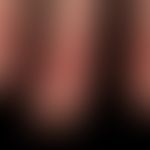 Lupus erythematodes chronicus discoides: älterer, ungewöhnliche lokalisierter Herd am Fingerrücke...