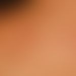 Kollagenose, reaktive perforierende: vor etwa&nbsp;8 Monaten erstmals aufgetretene, juckende Pape...